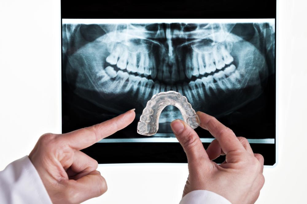 Dentist Edina MN What are occlusal guards used for?