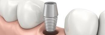 An illustration of a dental implant in Edina, MN