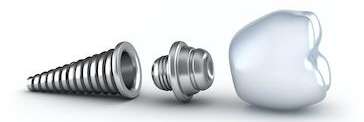 An illustration of a dental implant in Edina, MN