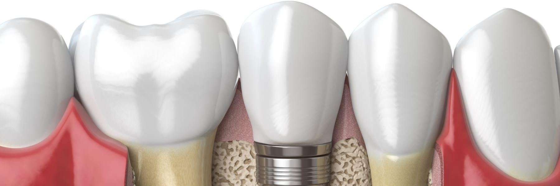 An illustration of dental implants in Edina, MN