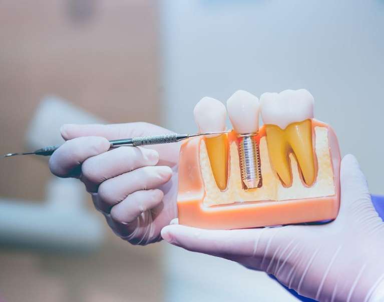dental implant illustration