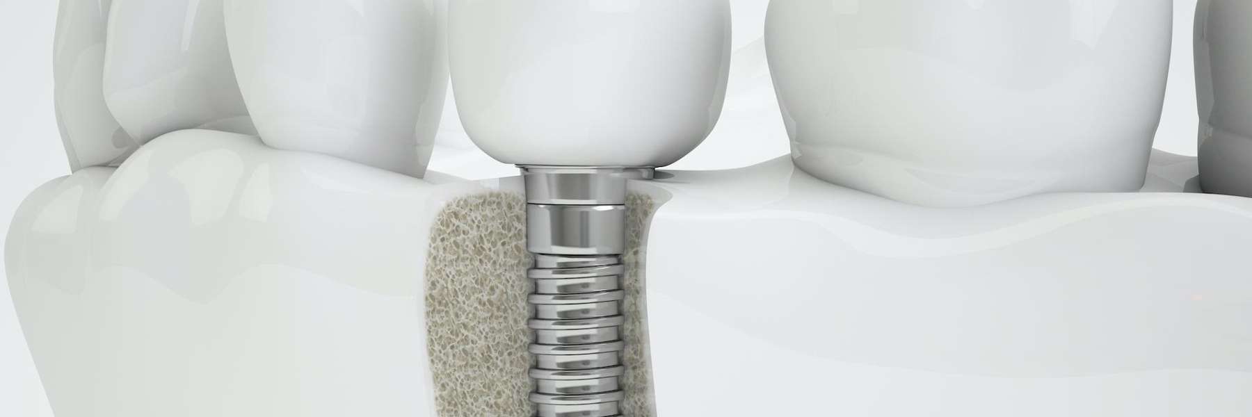 An illustration of a dental implant in Edina, MN
