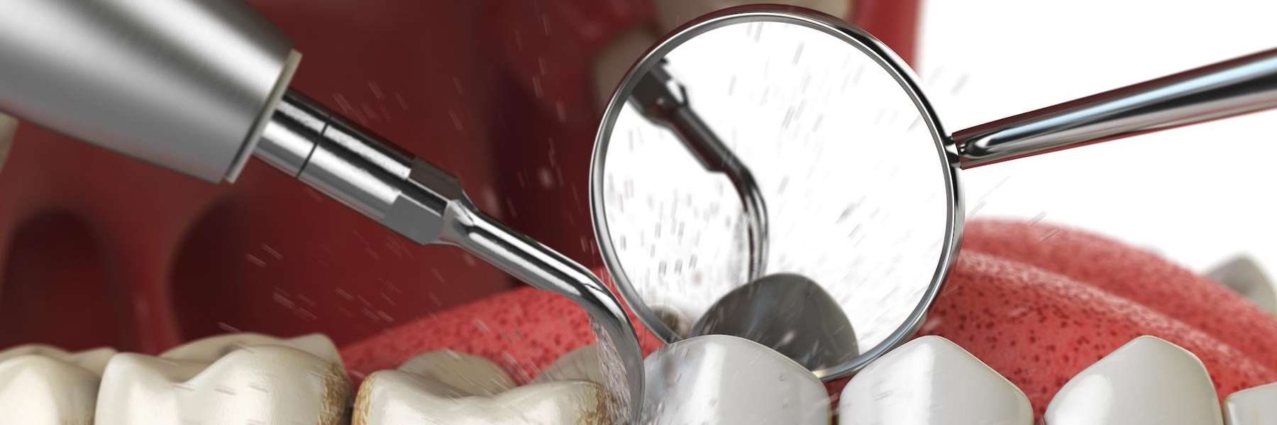 dental cleanings tools in edina mn
