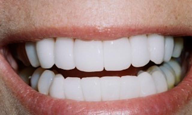 image of same teeth after cosmetic dentistry