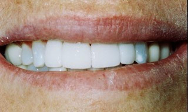 image of same teeth with veneers