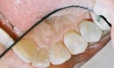 image of same teeth now with white Cerec restorations | edina mn