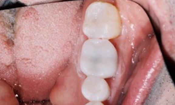 image of same teeth with white fillings and a cerec crown | edina mn