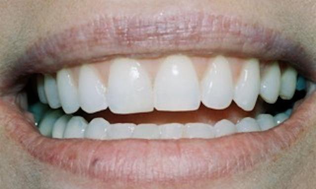 image of same teeth after smile makeover | composite bonding edina mn