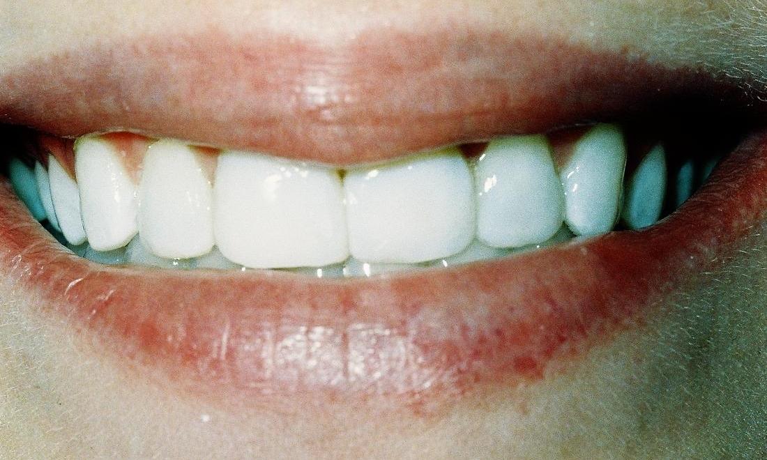 image of same teeth lengthened with veneers and composite bonding