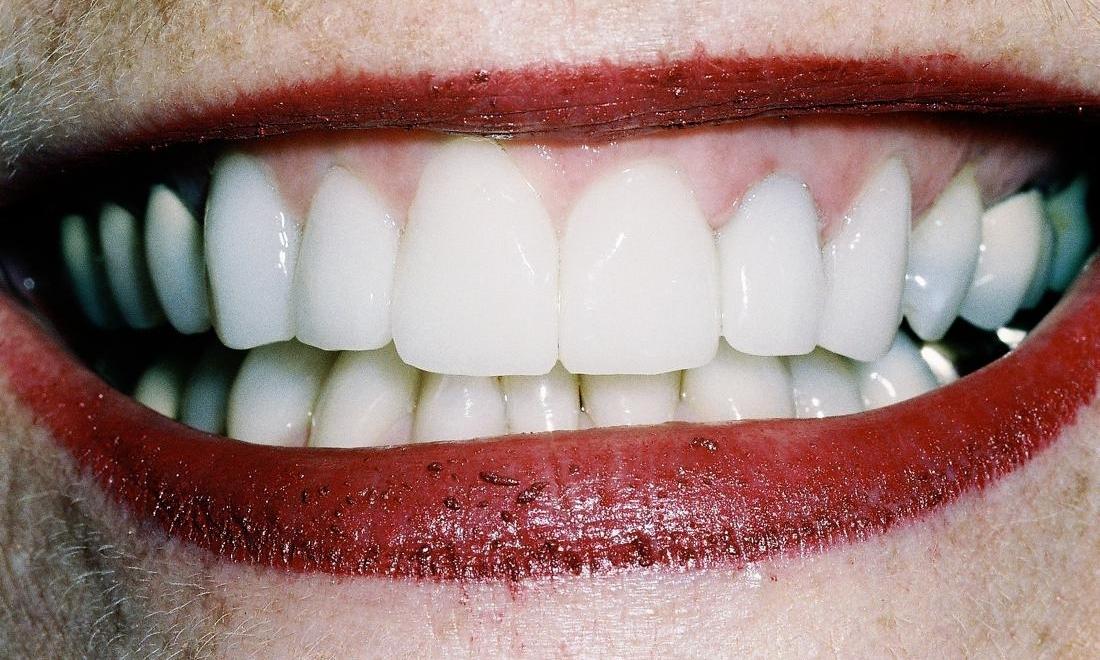 image of same teeth after straightening, crowns, and veneers