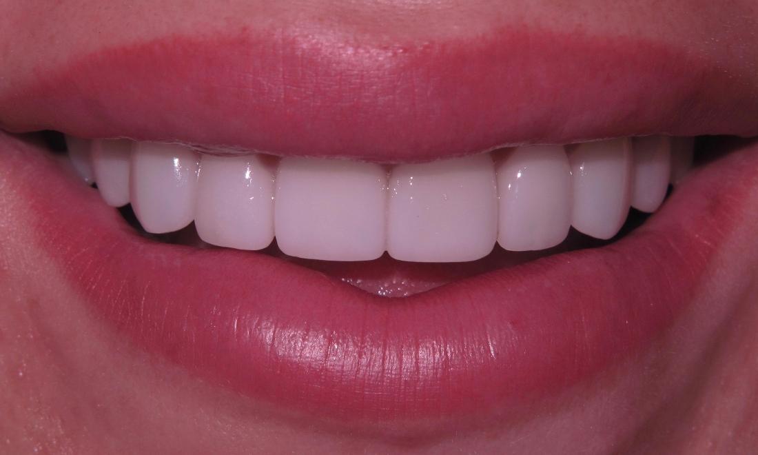 After photo of veneers on a woman in Edina MN