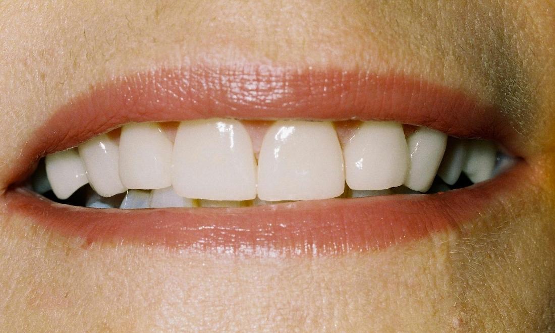 image of same teeth with veneers
