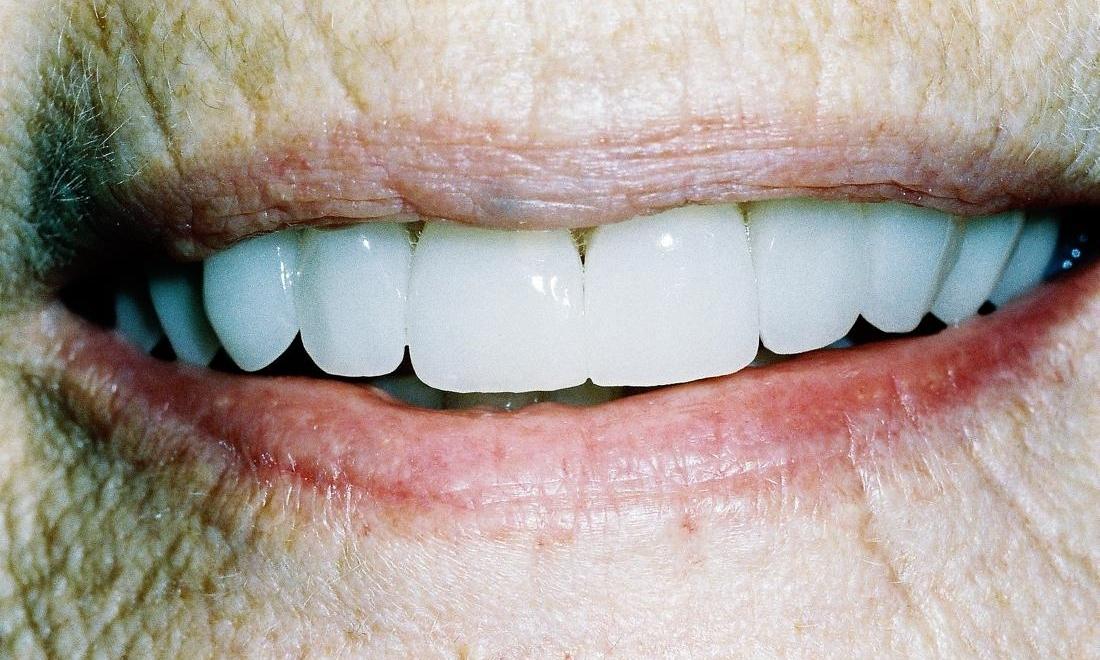 image of the same teeth but brighter and whiter thanks to veneers 