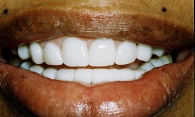 image of same teeth fixed with veneers | edina mn