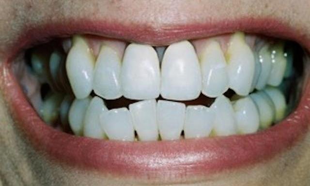 patient did not like the color or shape of her teeth