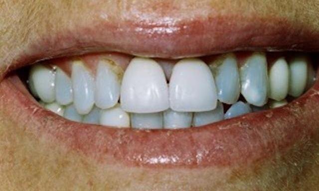 image of front four teeth with discoloration and improper shape