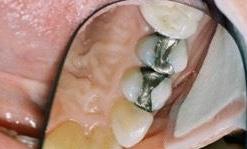 image of old silver fillings (mercury) 