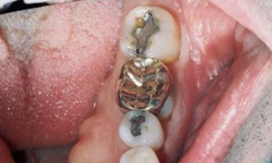 image of silver fillings and gold crown l dentist edina mn