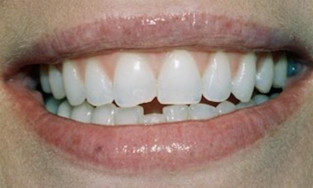 Image of chipped teeth 