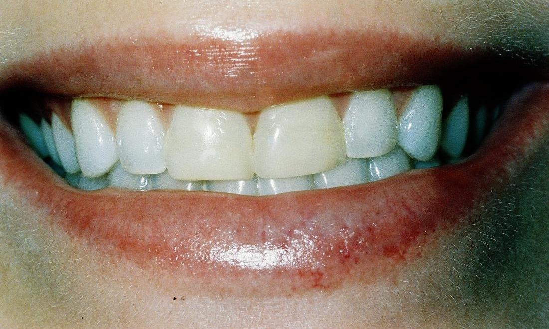 image of short and dark teeth l dentist edina mn