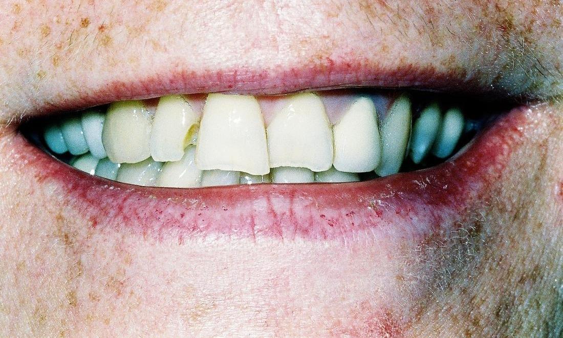 image of chipped and crooked teeth l edina mn dentist