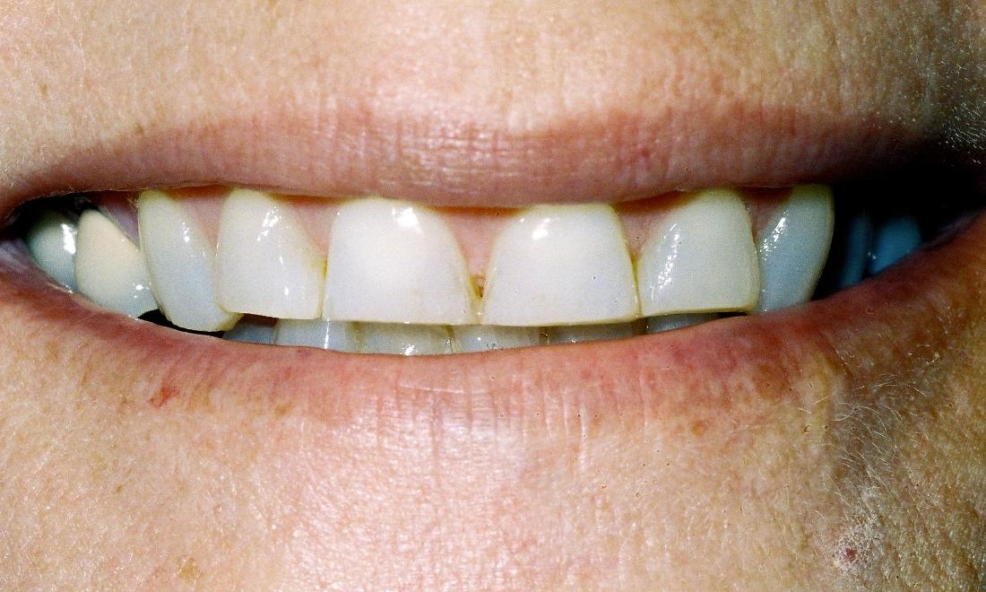 image of teeth in poor positions | edina mn