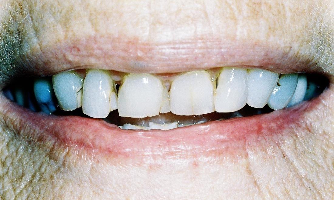 image of teeth with stains, wear, and chips