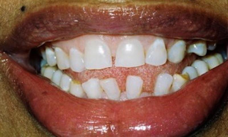 image of teeth with spaces between them