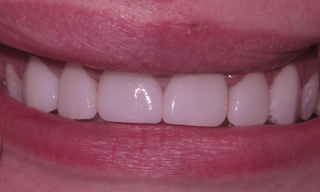 After combination of crowns and veneers were done