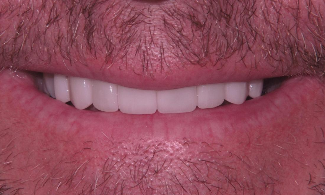 After Veneers to create a balanced smile