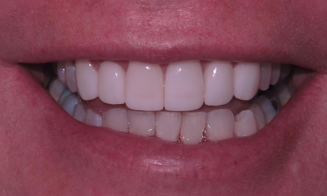 After 6 Veneers were placed to lighten the teeth