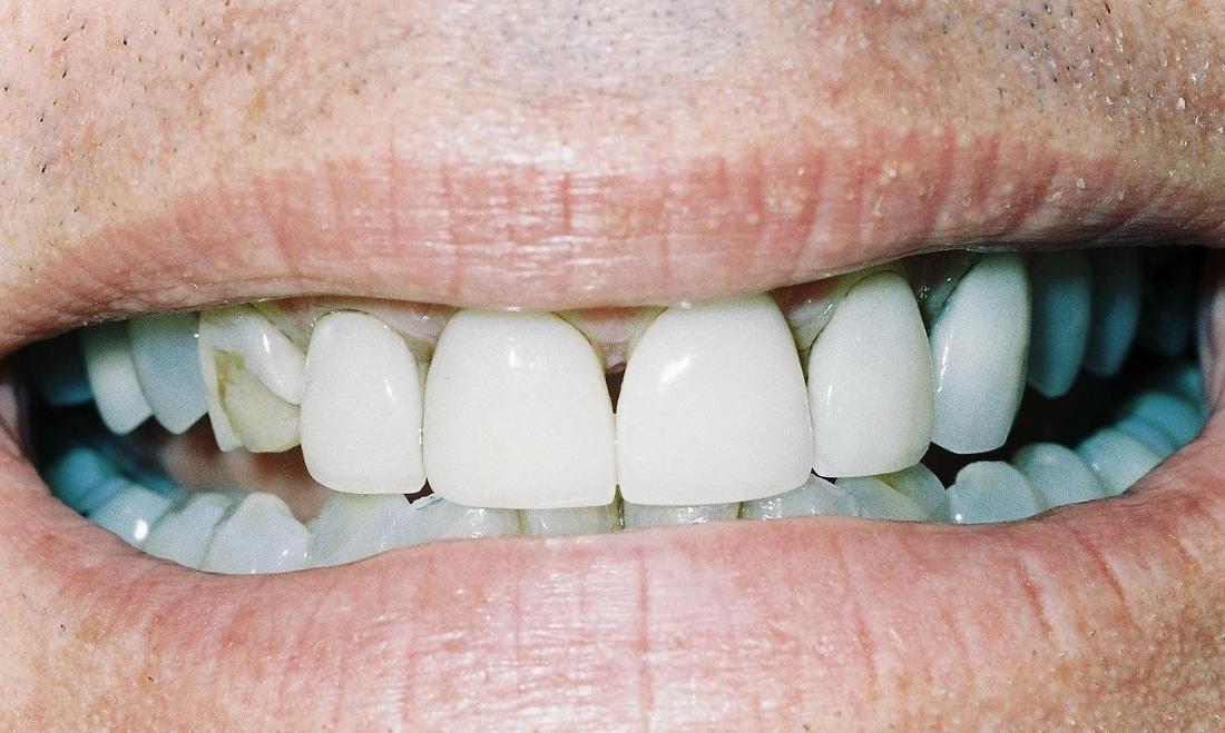 image of broken and stained teeth l cosmetic dentist edina mn