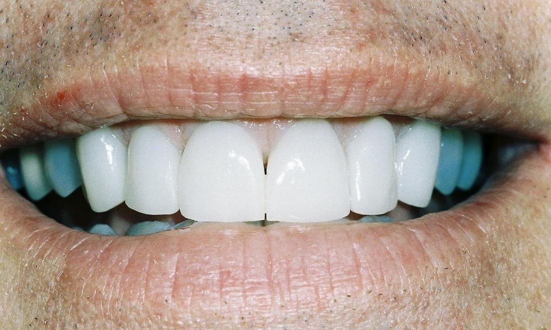image of same teeth fixed and lightened with veneers