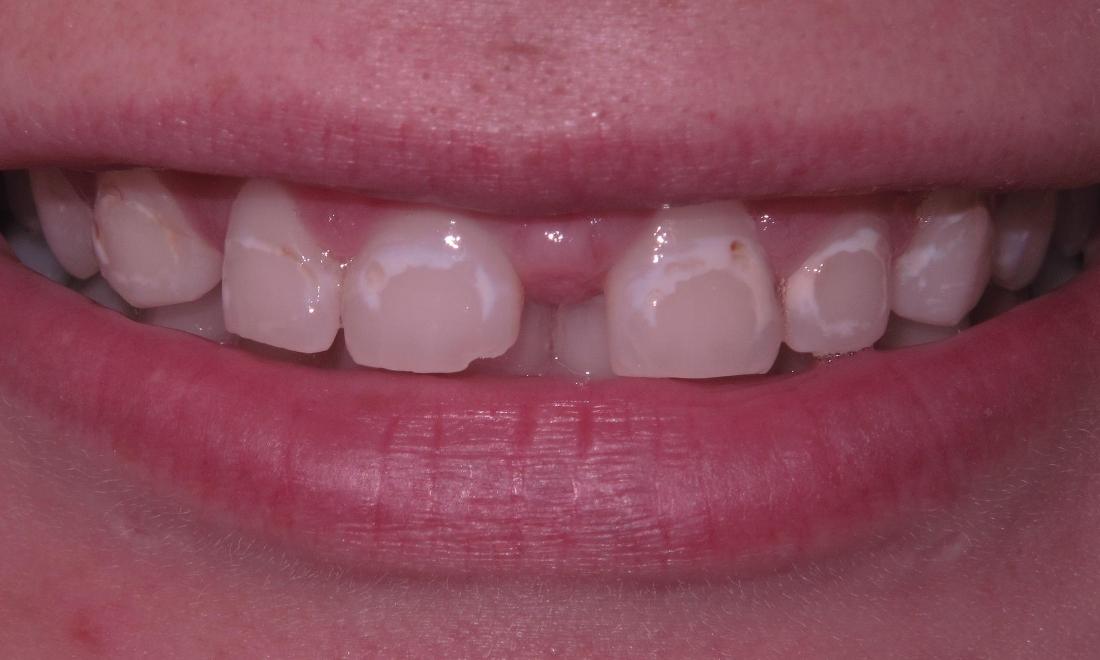Before combination of crowns and veneers