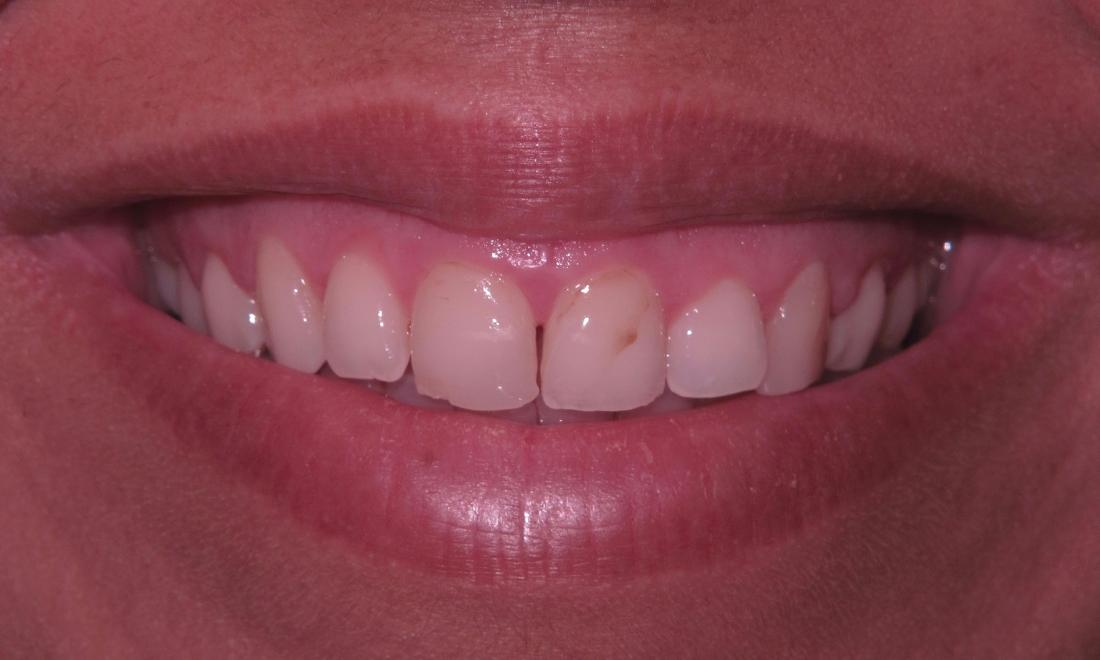Before Veneers for Two Front Teeth