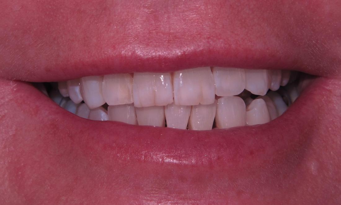 Before Veneers were placed to lighten the teeth
