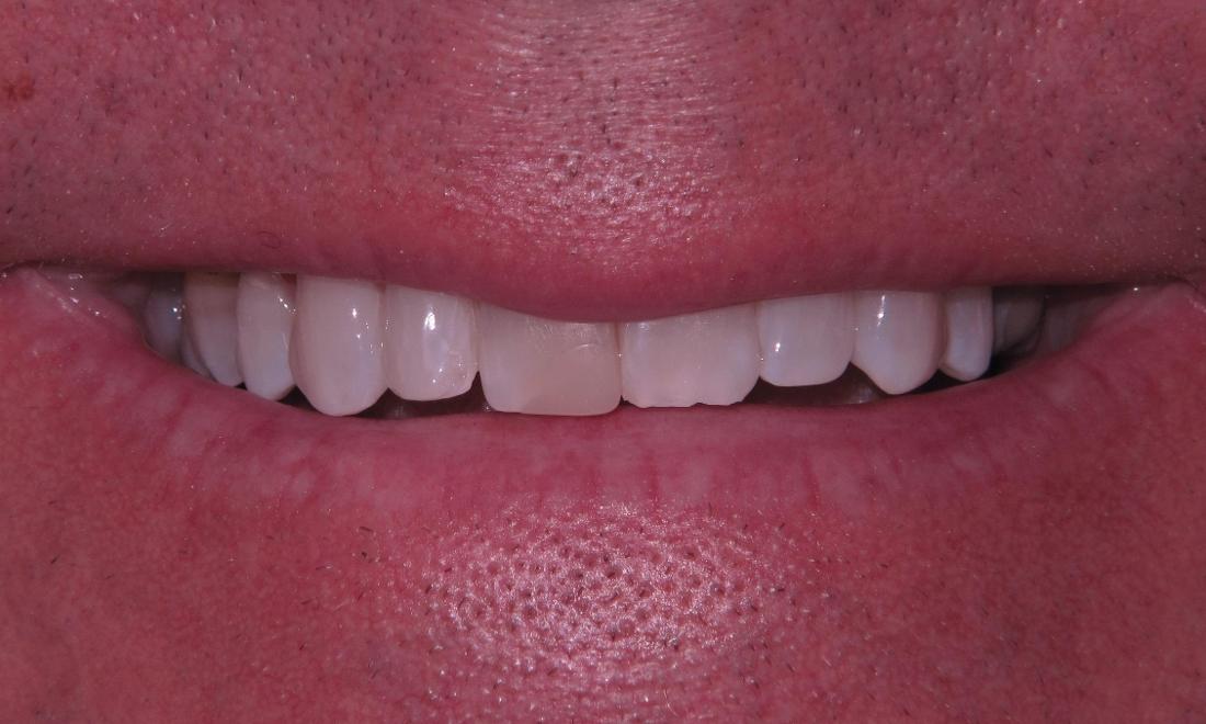 Before Veneers to create a balanced smile