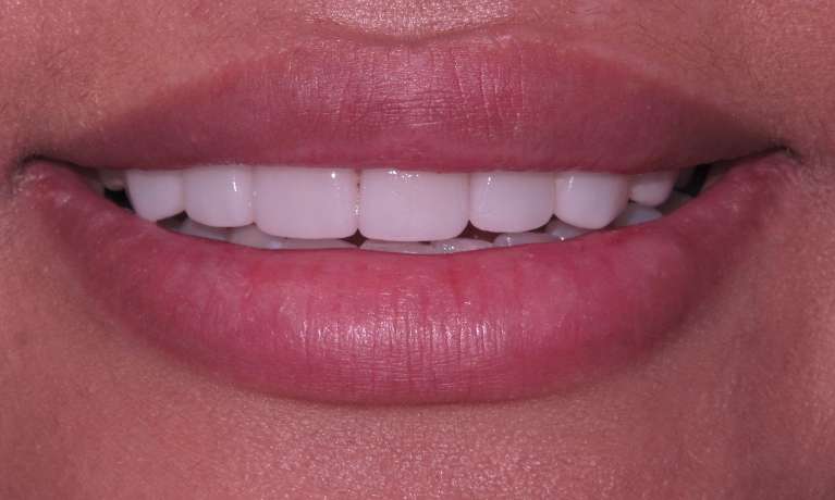 After off center smile corrected with veneers