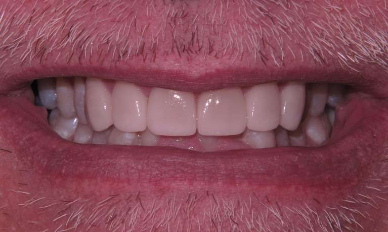Wear-and-tear-fixed-with-veneers-After-Image