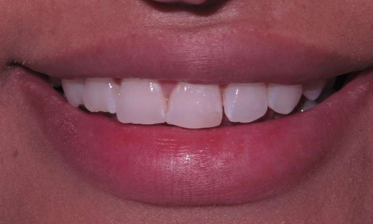 Before off center smile corrected with veneers