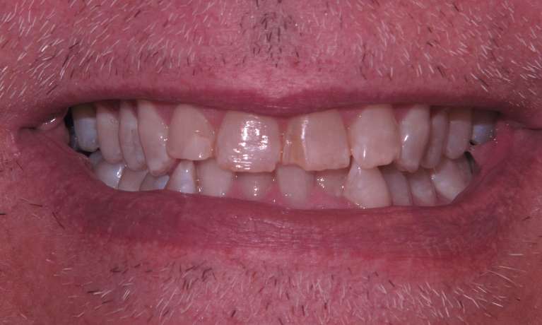 Wear-and-tear-fixed-with-veneers-Before-Image